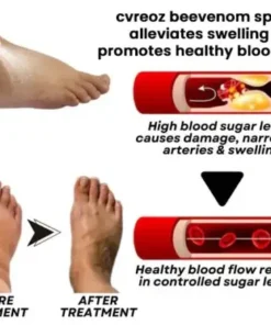 Bee Venom Diabetic Foot Treatment Spray