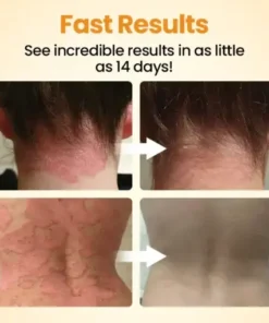 BeeLief Psoriasis Skin Care Cream