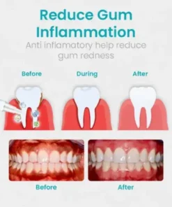 Gum Shield Therapy Gel