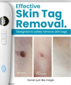 Home Use CO2 Laser Shot Erase Pro