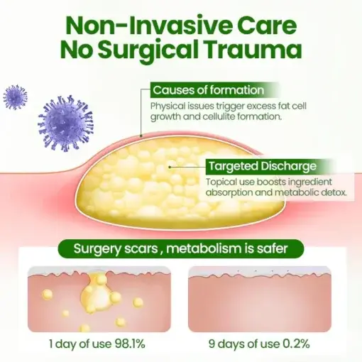 KnotAway Lipoma Removal Cream