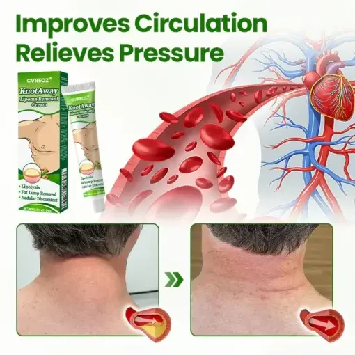 KnotAway Lipoma Removal Cream