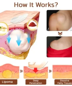 Lumpless Lipoma Treatment Cream