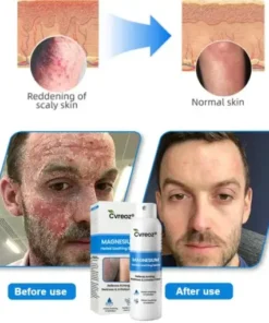 Magnesium Herbal Psoriasis Spray