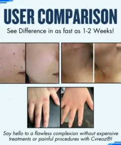Moles & Warts Removing Skin Tag Patch