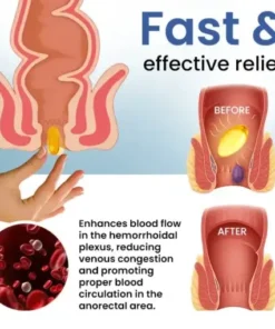 Natural Hemorrhoid Capsules