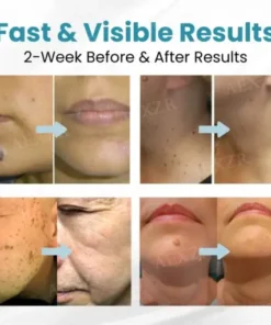 Non-Invasive Mole and Wart Removal Laser Pen