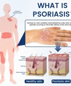 PsoriCure Magnesium Herbal Spray