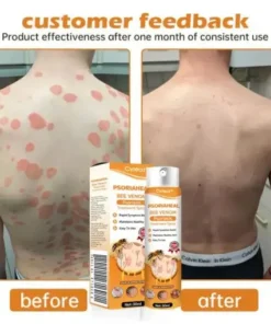 PsoriaHeal Bee Venom Psoriasis Treatment Spray