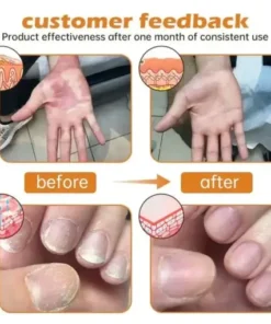 PsoriaHeal Bee Venom Psoriasis Treatment Spray