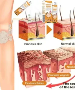 PsoriaHeal Bee Venom Psoriasis Treatment Spray