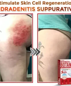 Skin Tag Removal Patch