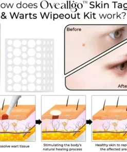 Skin Tags & Warts Wipeout Kit