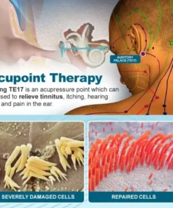 TinniCalm Tinnitus Treatment Ear Patch