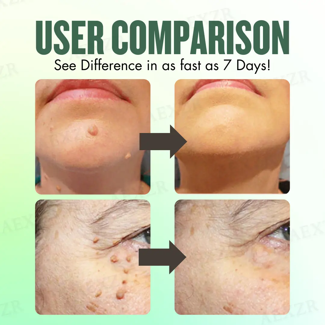 WartsOff Instant Blemish Removal Cream - Image 2