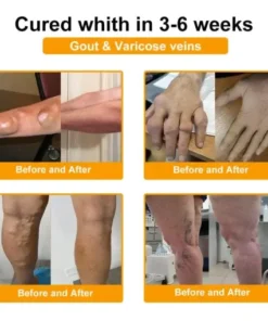 Botulinum Toxin & Bee Venom Pain-Relief Bone Healing Cream