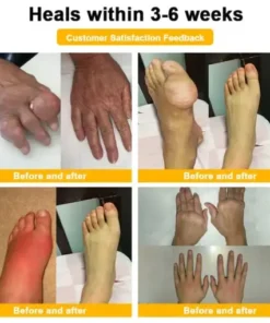 Botulinum Toxin & Bee Venom Pain-Relief Bone Healing Cream