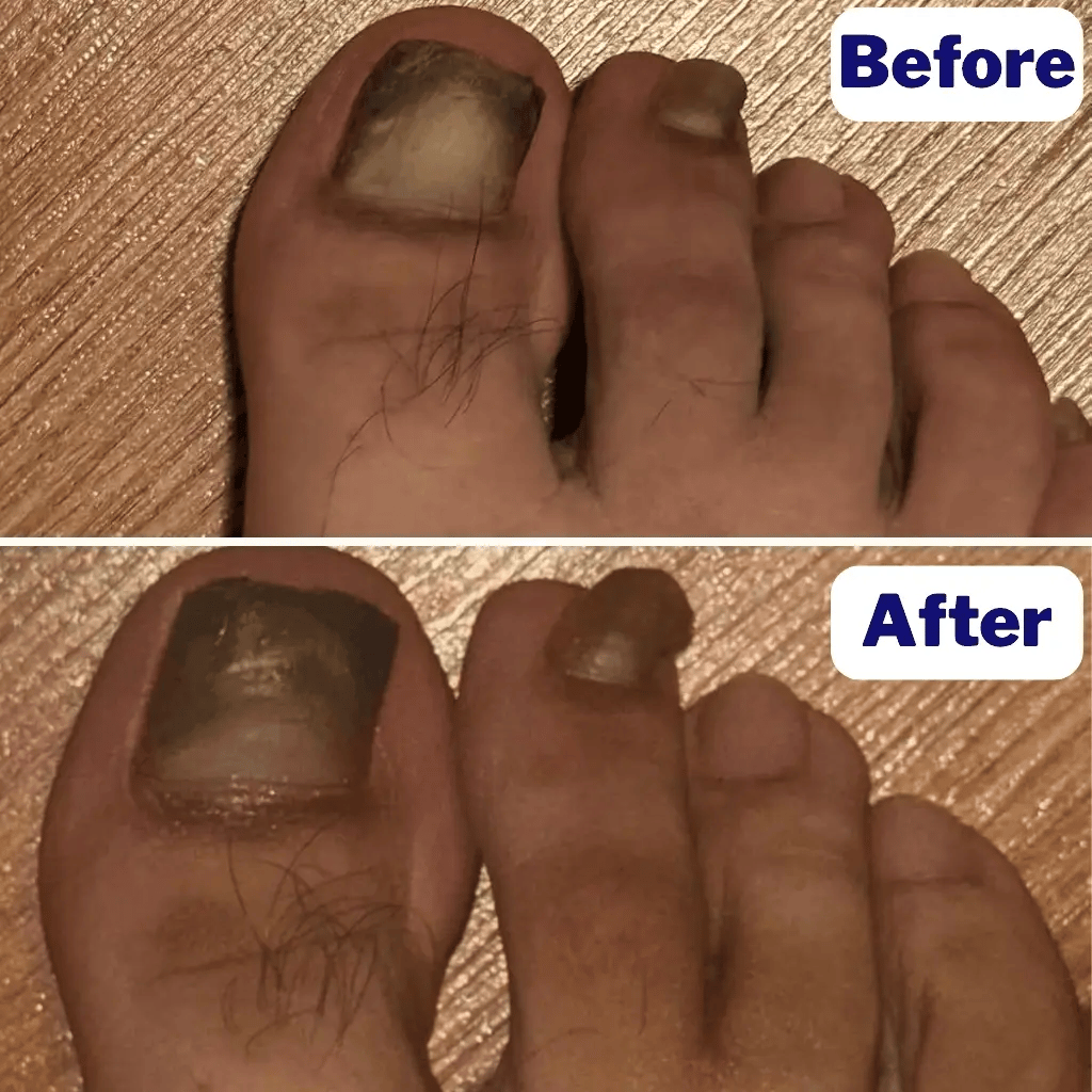 - Fungal Nail Patches - Image 2