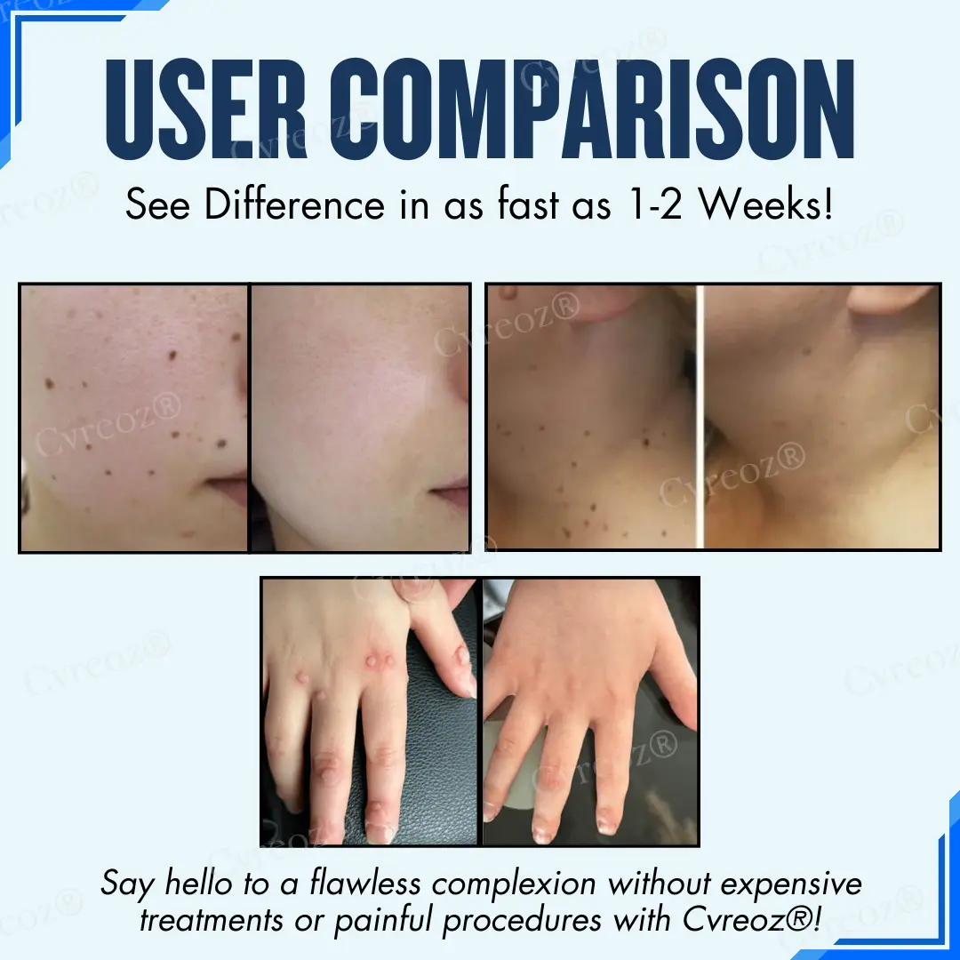 Moles & Warts Removing Skin Tag Patch - Image 2