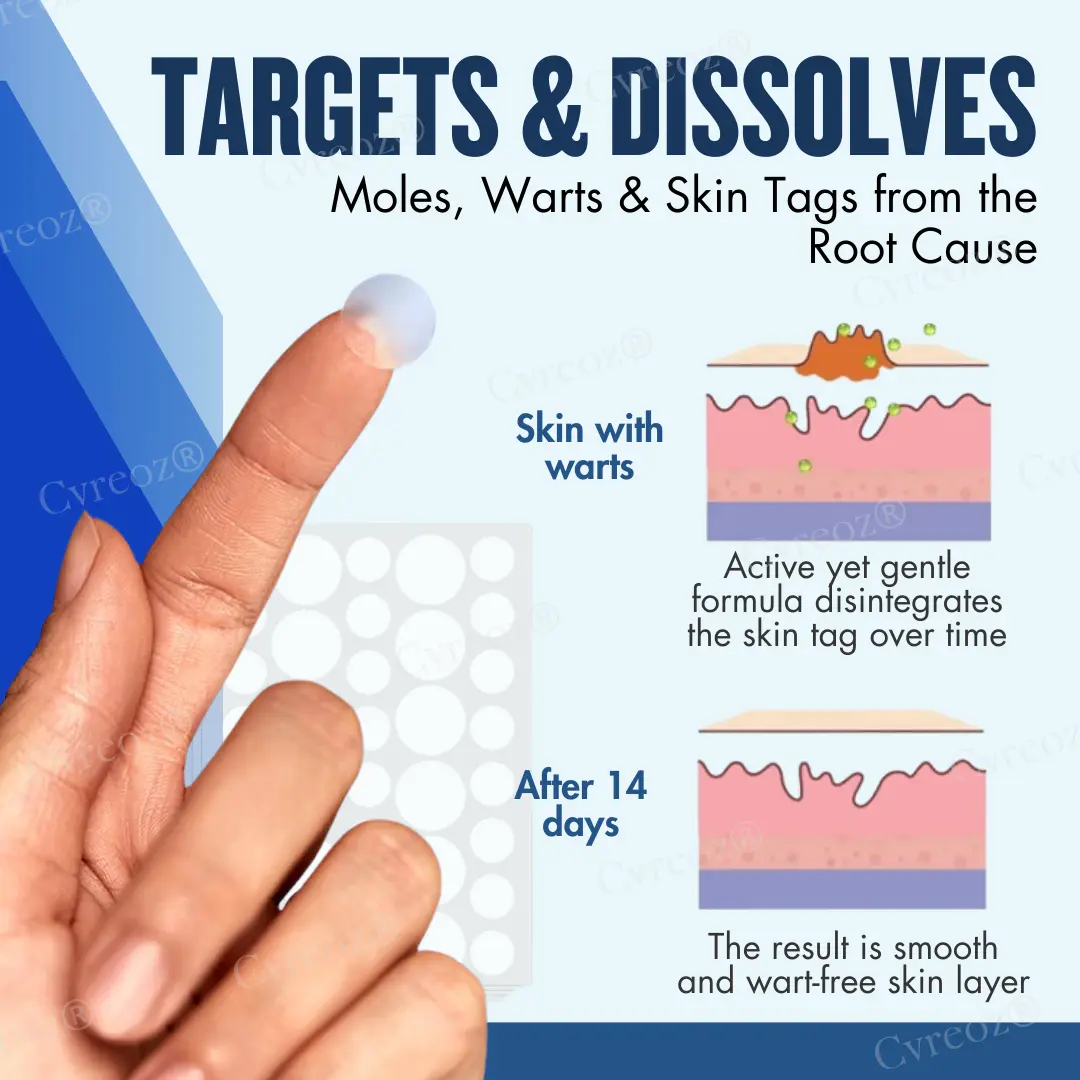 Moles & Warts Removing Skin Tag Patch - Image 6