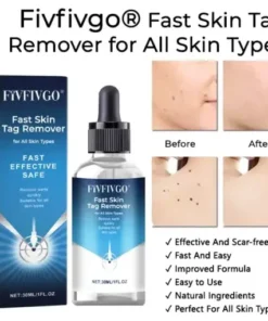 Fast Skin Tag Remover for All Skin Types
