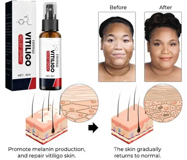 Vitiligo Relief Spray - Image 2