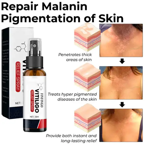 Vitiligo Relief Spray - Image 4