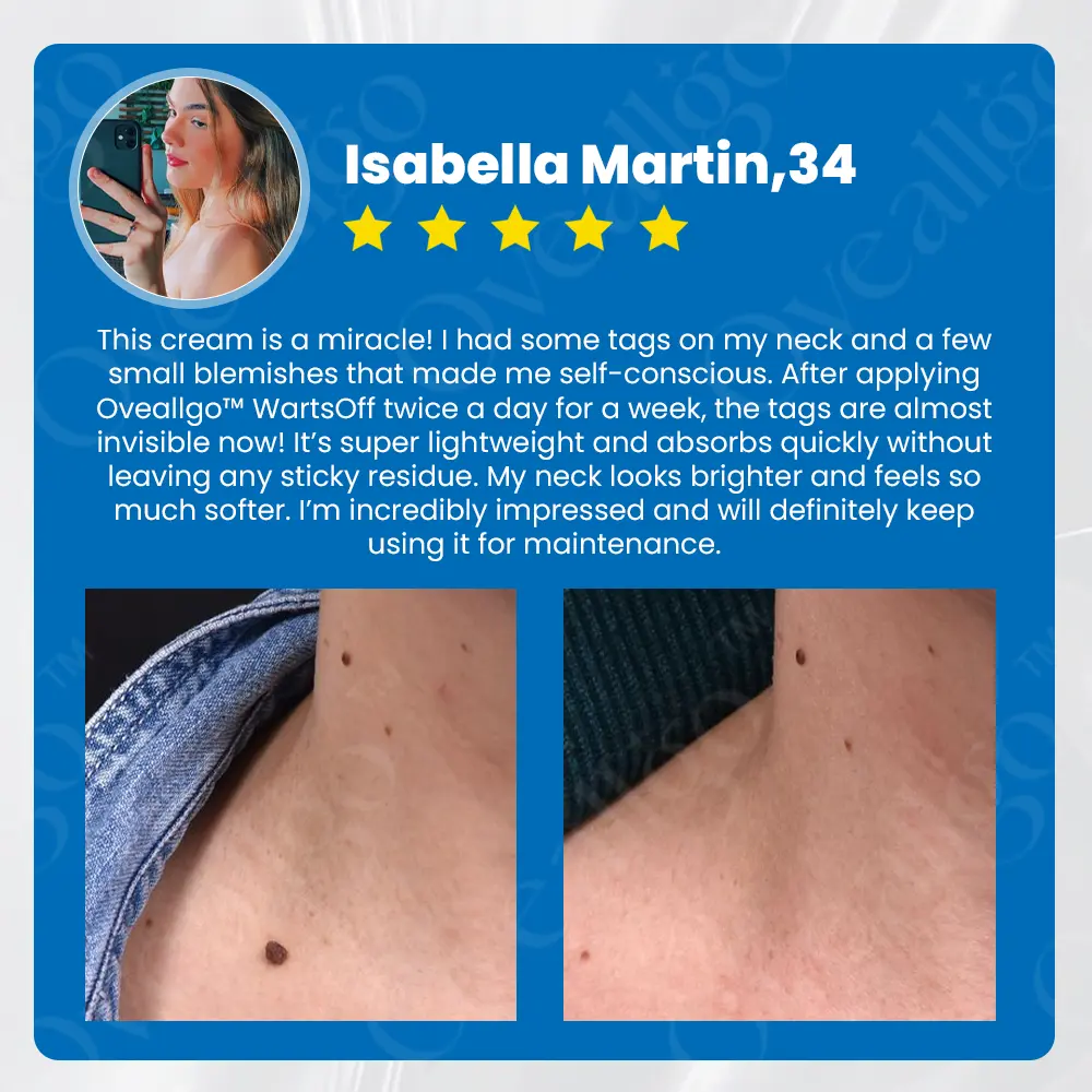 WartsOff Instant Blemish Removal Cream - Image 6