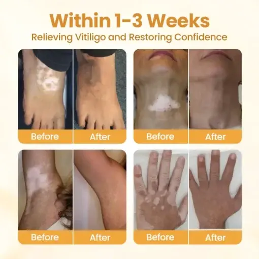 VitiClear Pro Bee Venom Cream