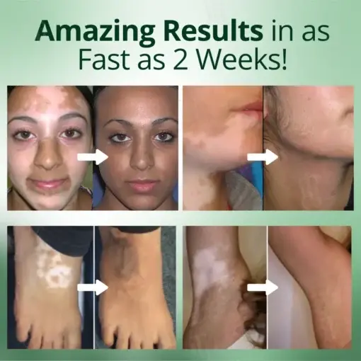 Vitiligo Treatment Cream