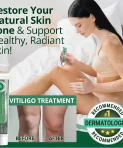 Vitiligo Treatment Cream