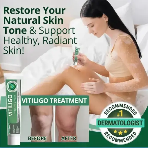 Vitiligo Treatment Cream