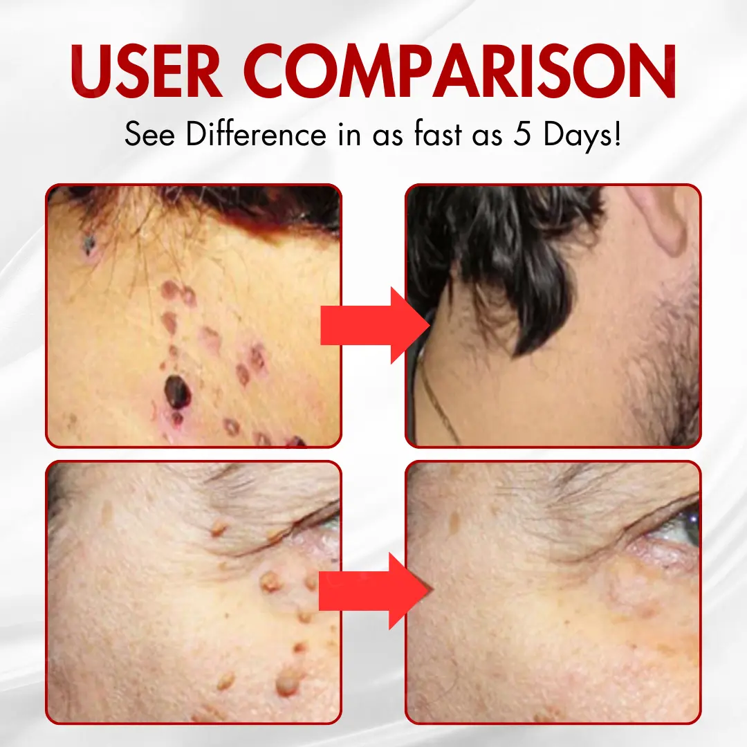 Nano-Microdart Skin Tag & Spot Corrector Patches - Image 2