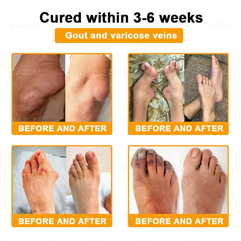 Bee Venom Pain-Relief Bone Healing Cream - Image 4